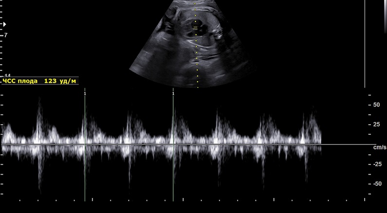 USG vyšetření srdeční frekvence u plodu