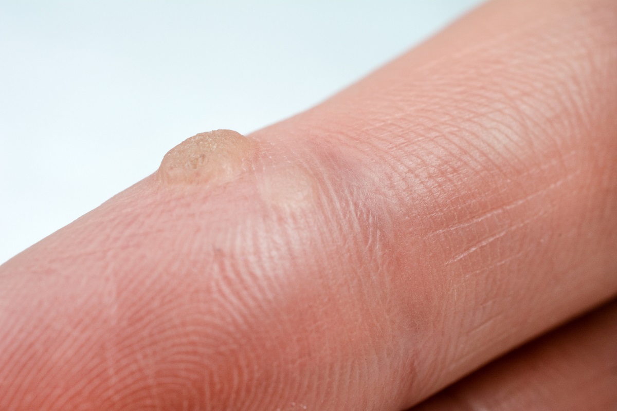 Bežná bradavica guľatého vyvýšeného tvaru na prste. Zdroj: Getty Images