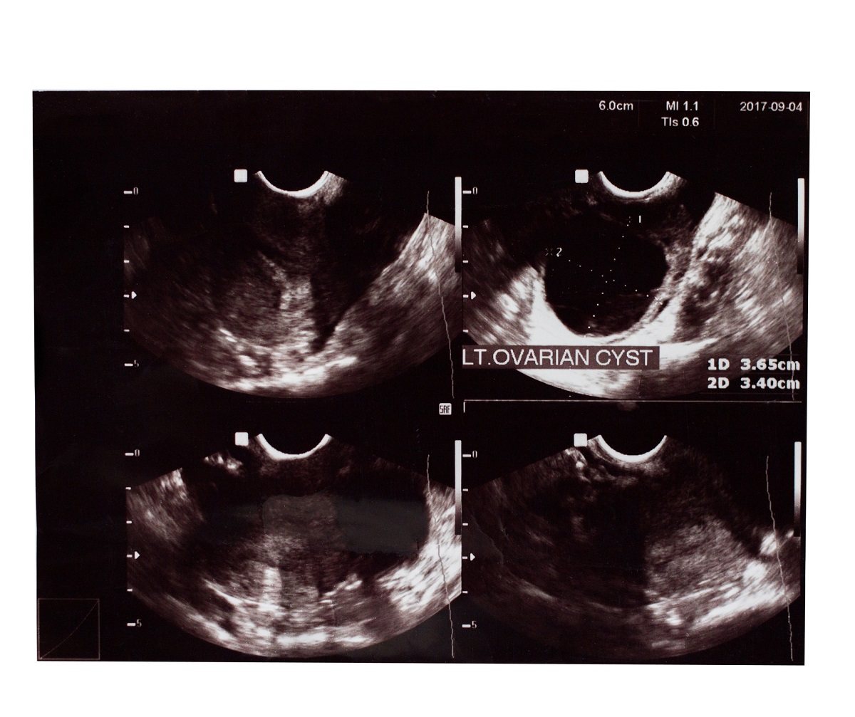 Sonografické vyšetrenie vaječníkov a potvrdenie výskytu cysty na vaječníkoch. Zdroj: Getty Images