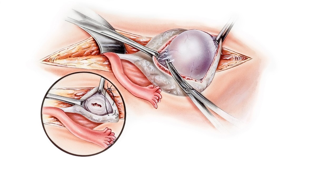 Surgical removal of a cyst from the ovary