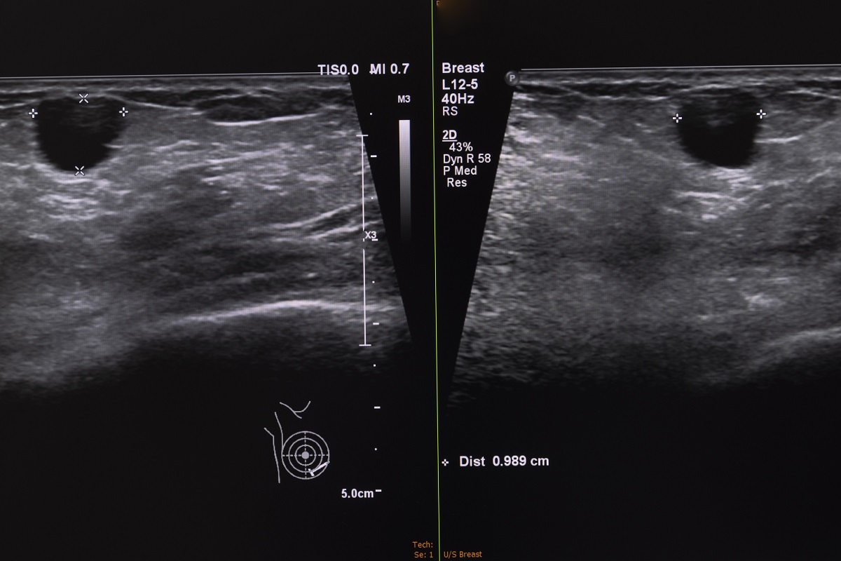 Sonografické zobrazenie cysty v prsníku. Zdroj: Getty Images