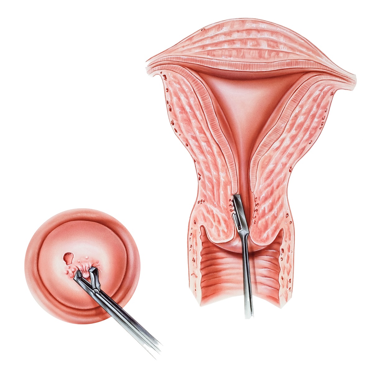 A biopsy is the taking of a tissue sample from the cervix. Source: Getty Images.