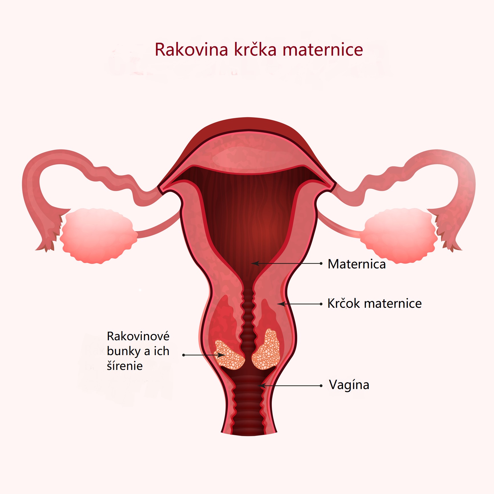 Rakovina krčka maternice a jej šírenie. Zdroj: Getty Images