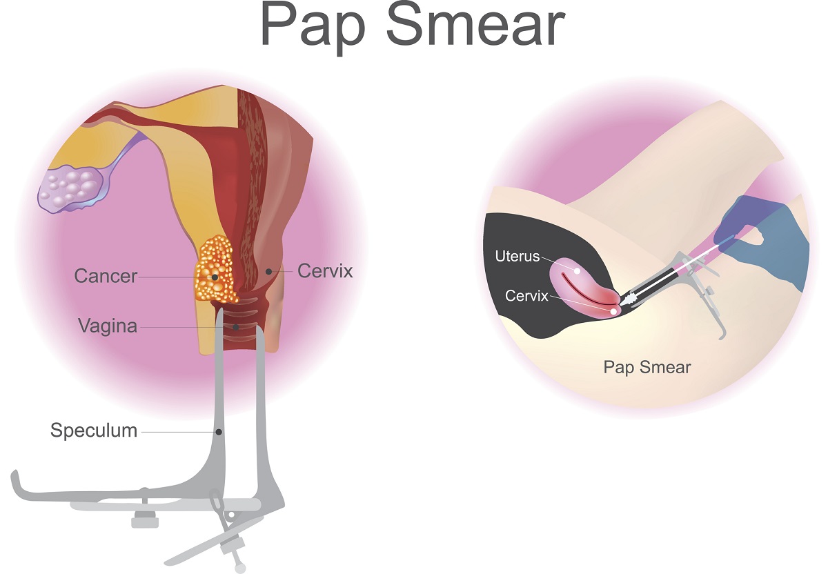 Screening examination, cervical smear. Source.