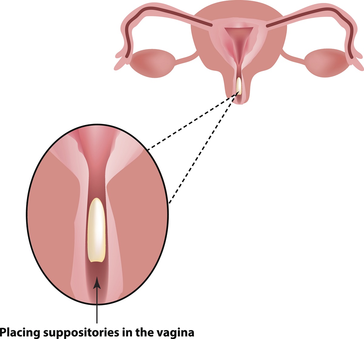 Application of the suppository into the vagina. Photo source: Getty Images.
