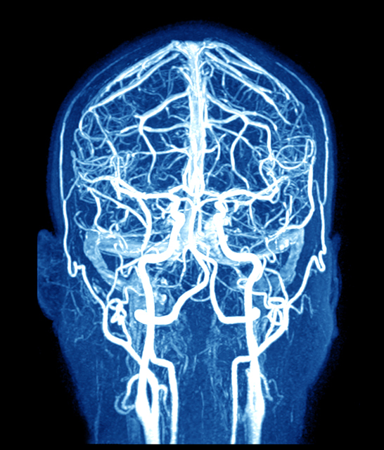 MRI mozgu a mozgové cievy