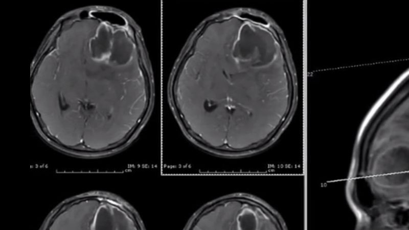 Absces mozgu