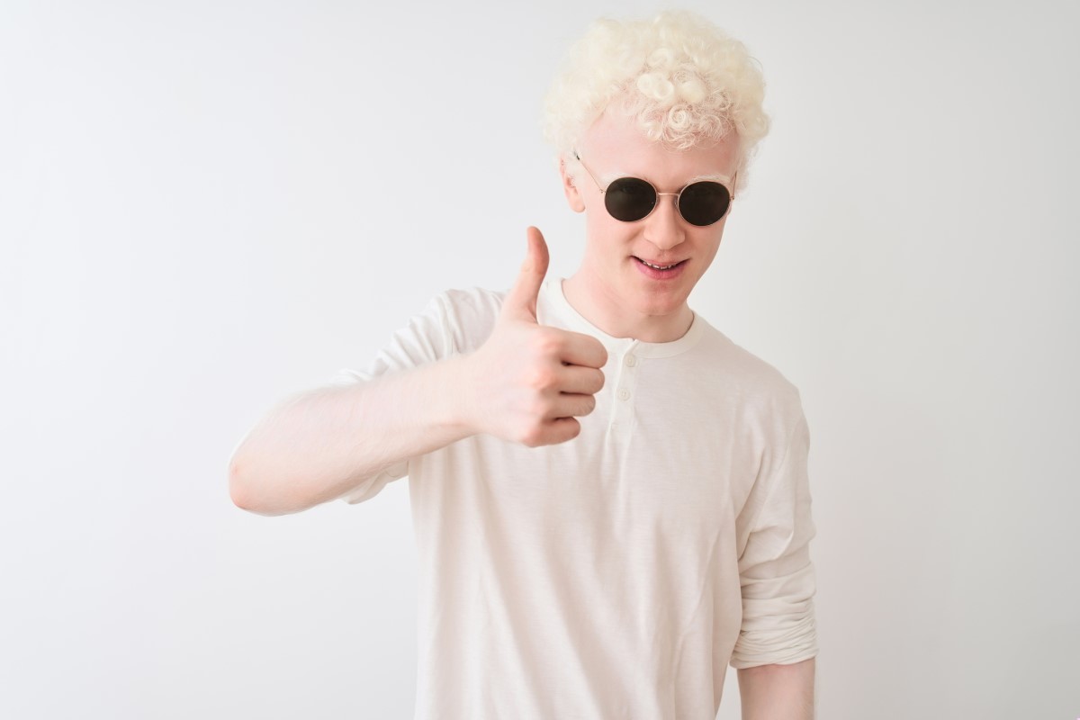 Albinizmus