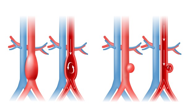 Aneuryzma aorty a prúdenie krvi