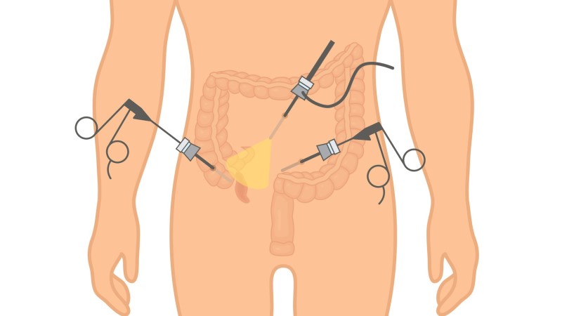 Modelové znázornenie laparoskopie pri apendicitíde