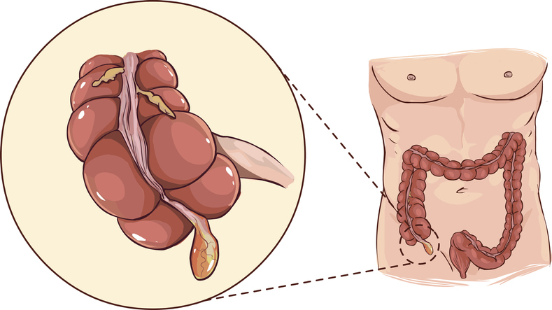 Apendix - slepé črevo hovorovo - anatomické znázornenie na začiatku hrubého čreva