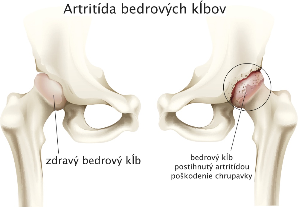 Artritída bedrového kĺbu