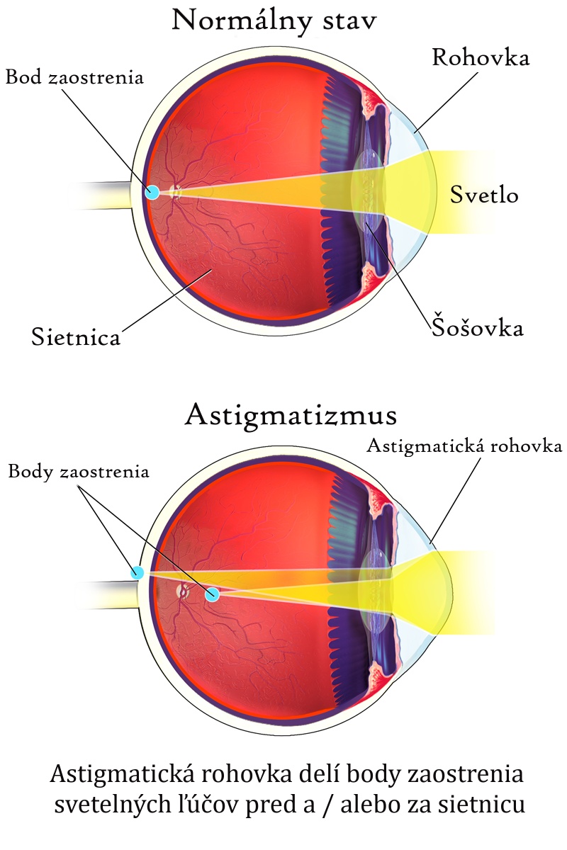 Anatomické znázornenie lomu svetelných lúčov pri normálnom stave oka a pri astigmatizme