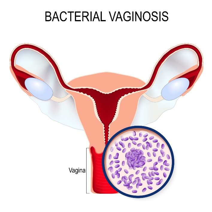 Bakteriálna vaginóza a premnoženie baktérie Gardnerella vaginalis