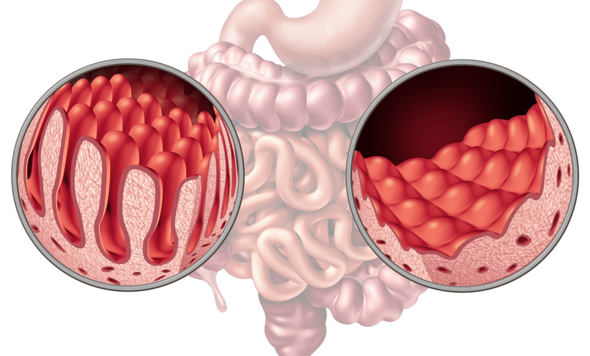 Črevo a klky, kde dochádza k vstrebávaniu živín, porovnanie: zdravé a poškodené celiakiou