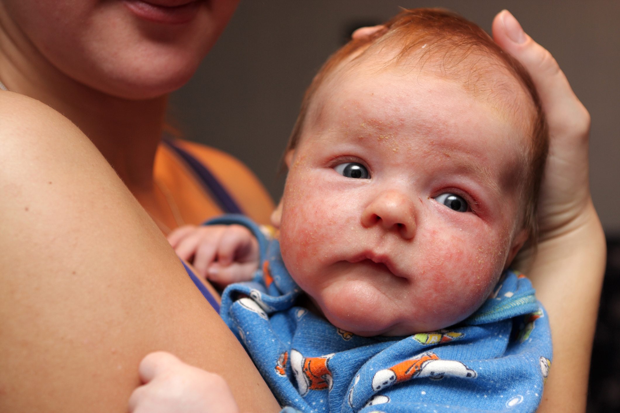 Dermatitída na tvári malého dieťaťa