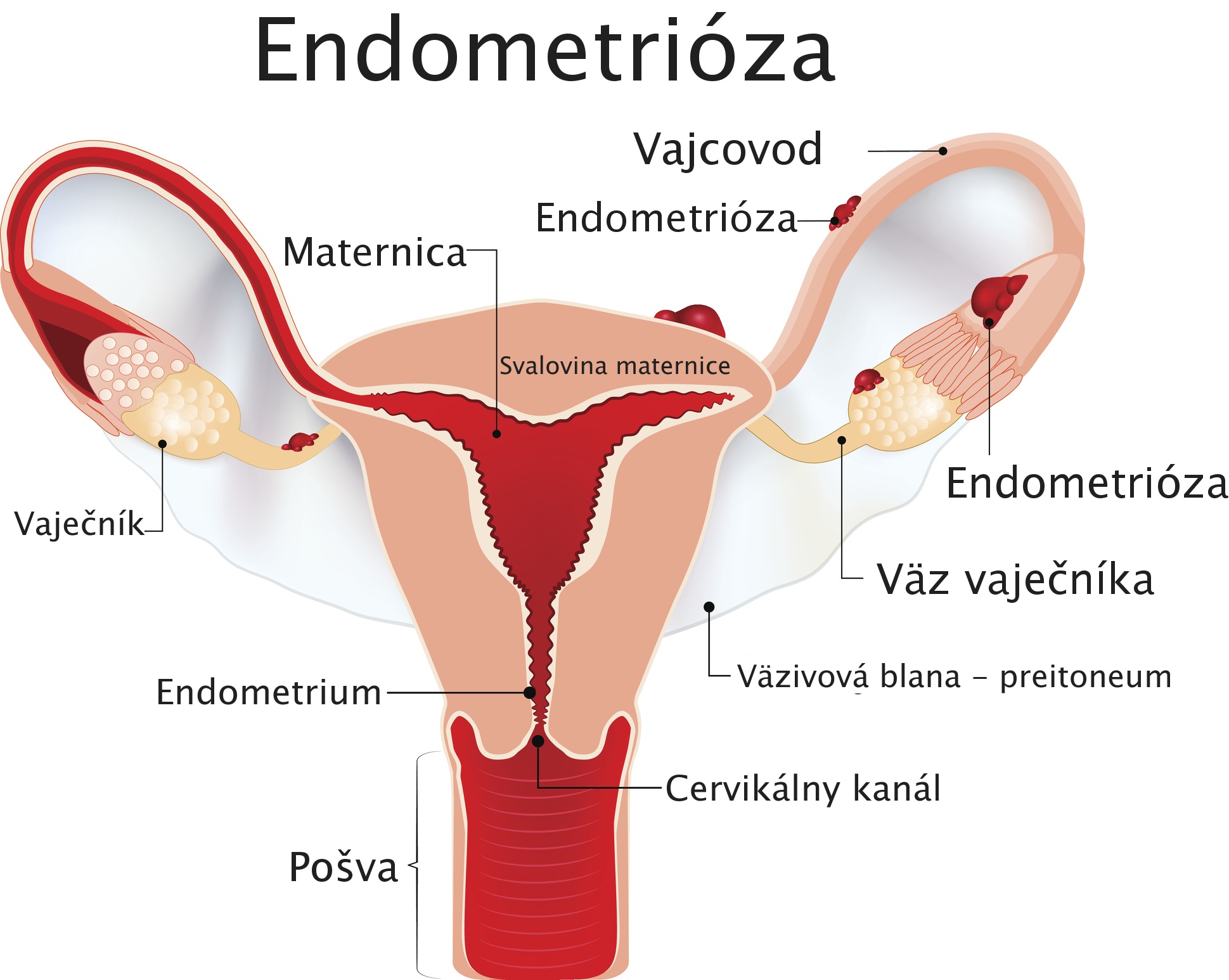 Endometrióza - model maternice s popisom