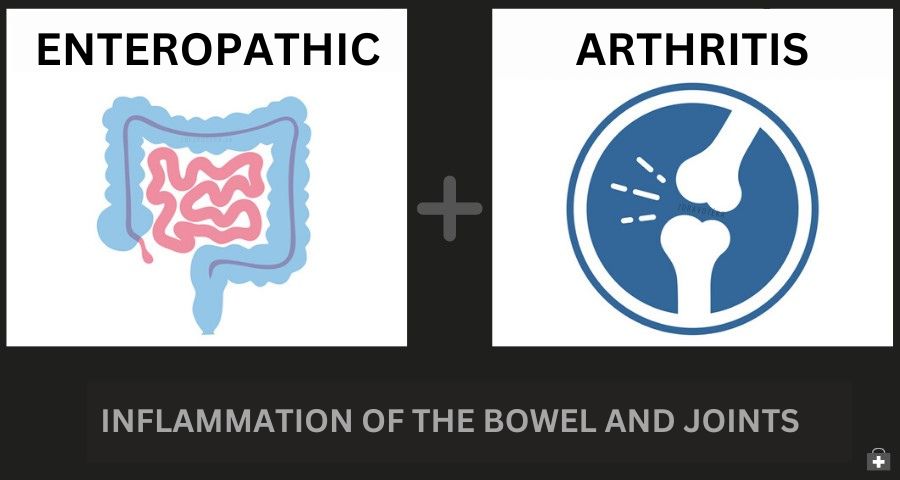 Enteropatická artritída a zápal čreva: Ako spolu súvisia? + Príznaky