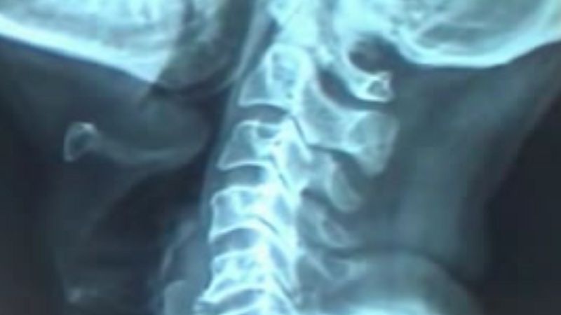 Epiglotitída