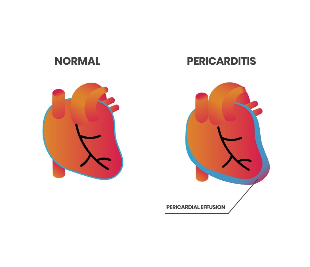 Fyziológia srdca a perikarditída (perikardiálny výpotok)