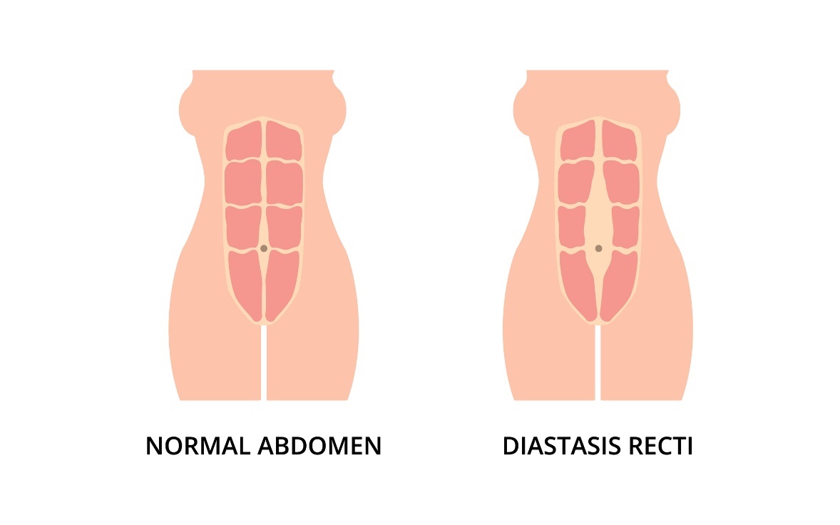 Fyziologický stav brušného svalstva a diastáza (rozostup) ľavého a pravého priameho brušného svalu od stredovej čiary linea alba