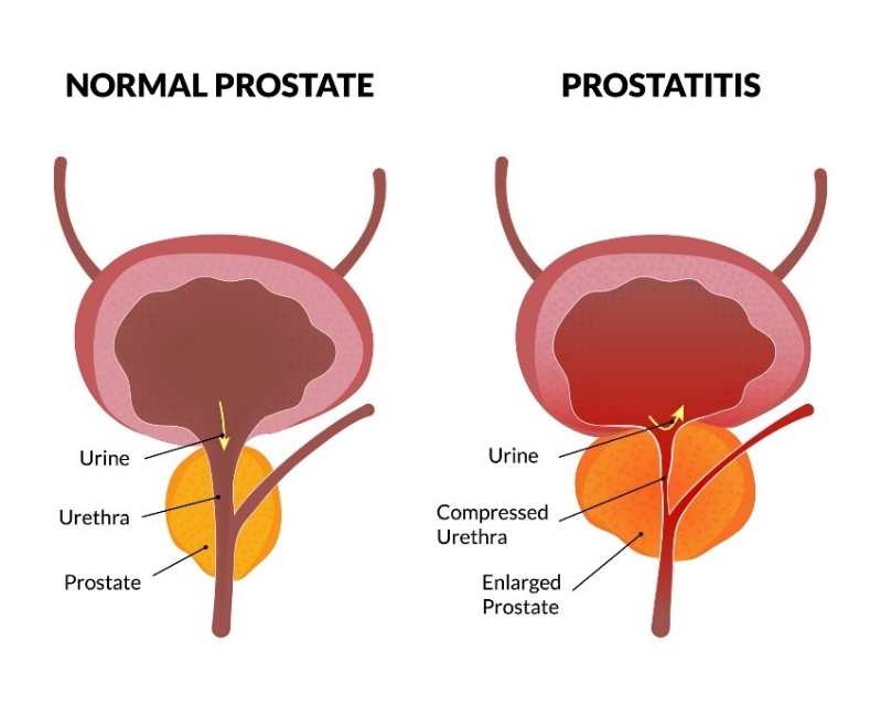 Fyziologický stav prostaty a Prostatitída