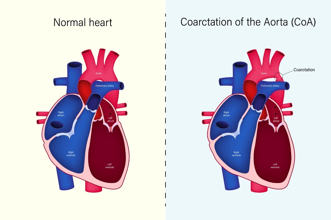 Fyziologický stav srdca a koarktácia aorty (CoA)