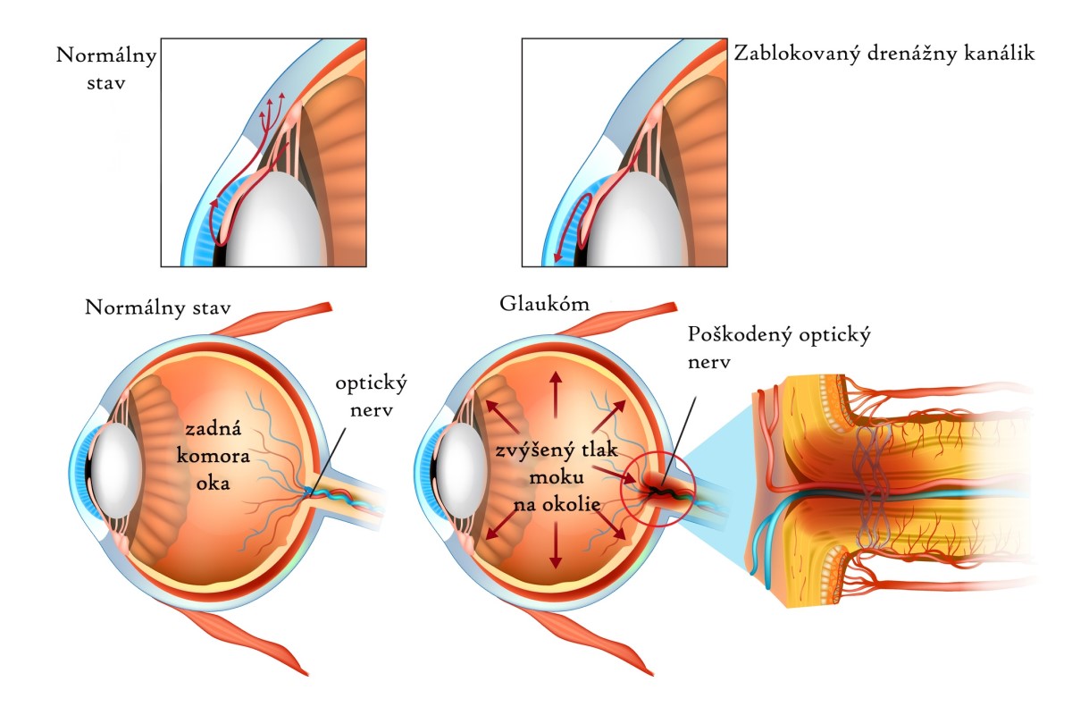Oko - porovnanie pri glaukóme a normálny stav - anatomické zobrazenie