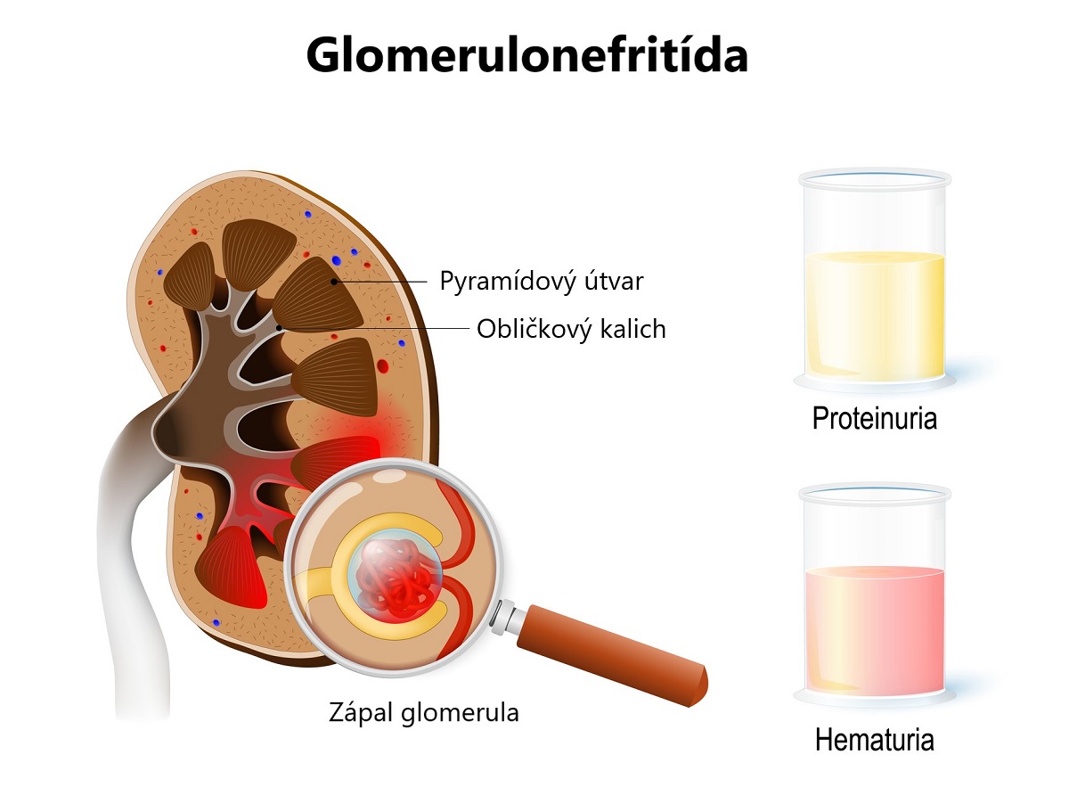 Glomerulonefritída 