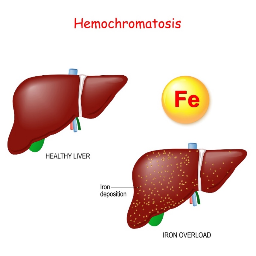 Hemochromatóza: fyziológia pečene a patológie pečene s nadmerným ukladaním železa (Fe)