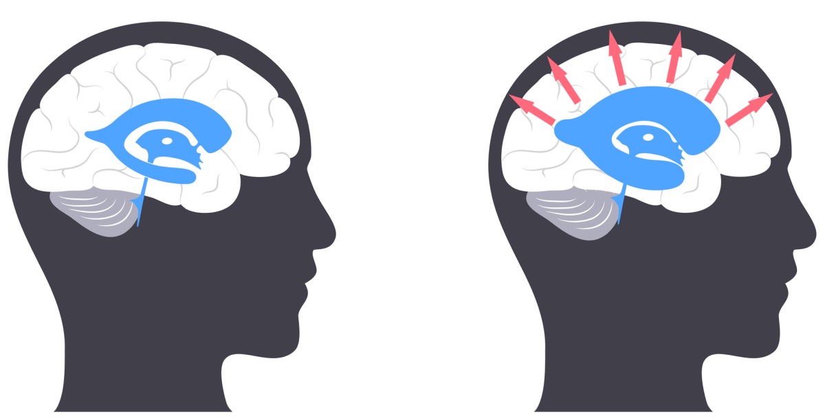 Hlava s mozgom - Normálny stav mozgu naľavo / Napravo - hlava s mozgom s hydrocefalom, kde šípky zo stredu smerom von naznačujú rozpínanie komôr a tlak na mozgové tkanivo