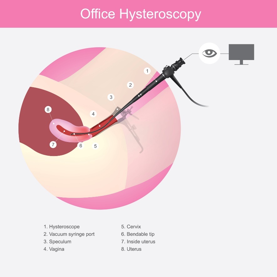 Hysteroskopia