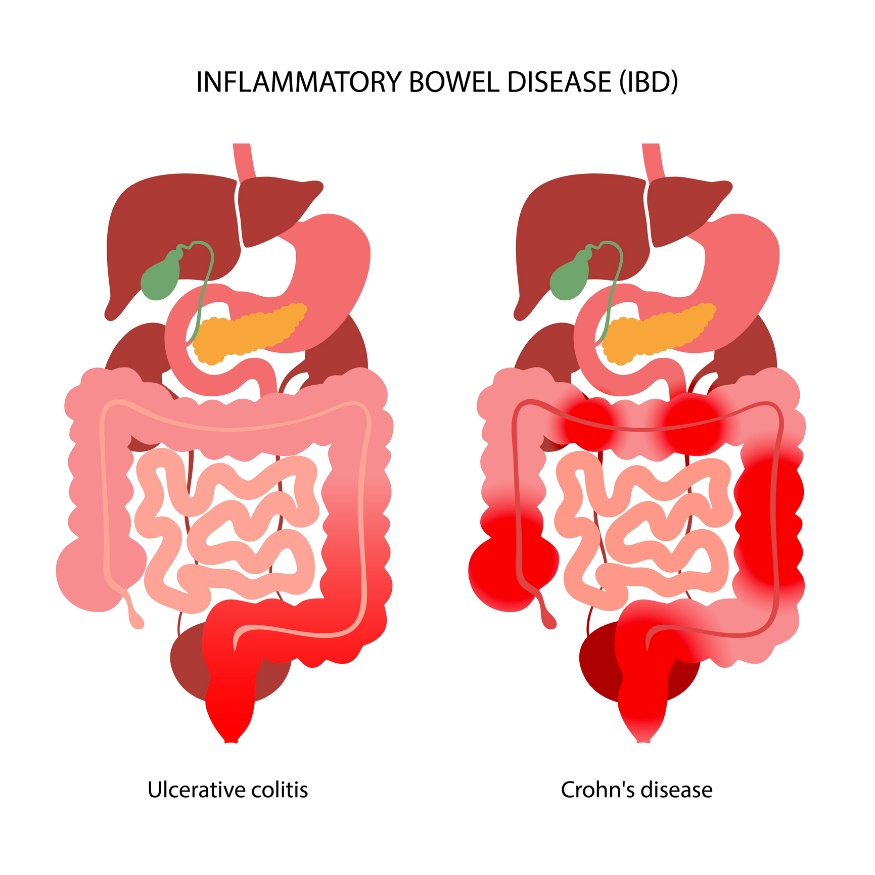 IBD: Delenie na Ulcerózna kolitídu a Crohnovu chorobu podľa lokalizácie zápalovej reakcie