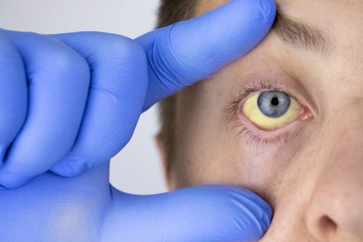 Ikterus, žltačka - žlté očné bielko ako príznak poruchy funkcie pečene