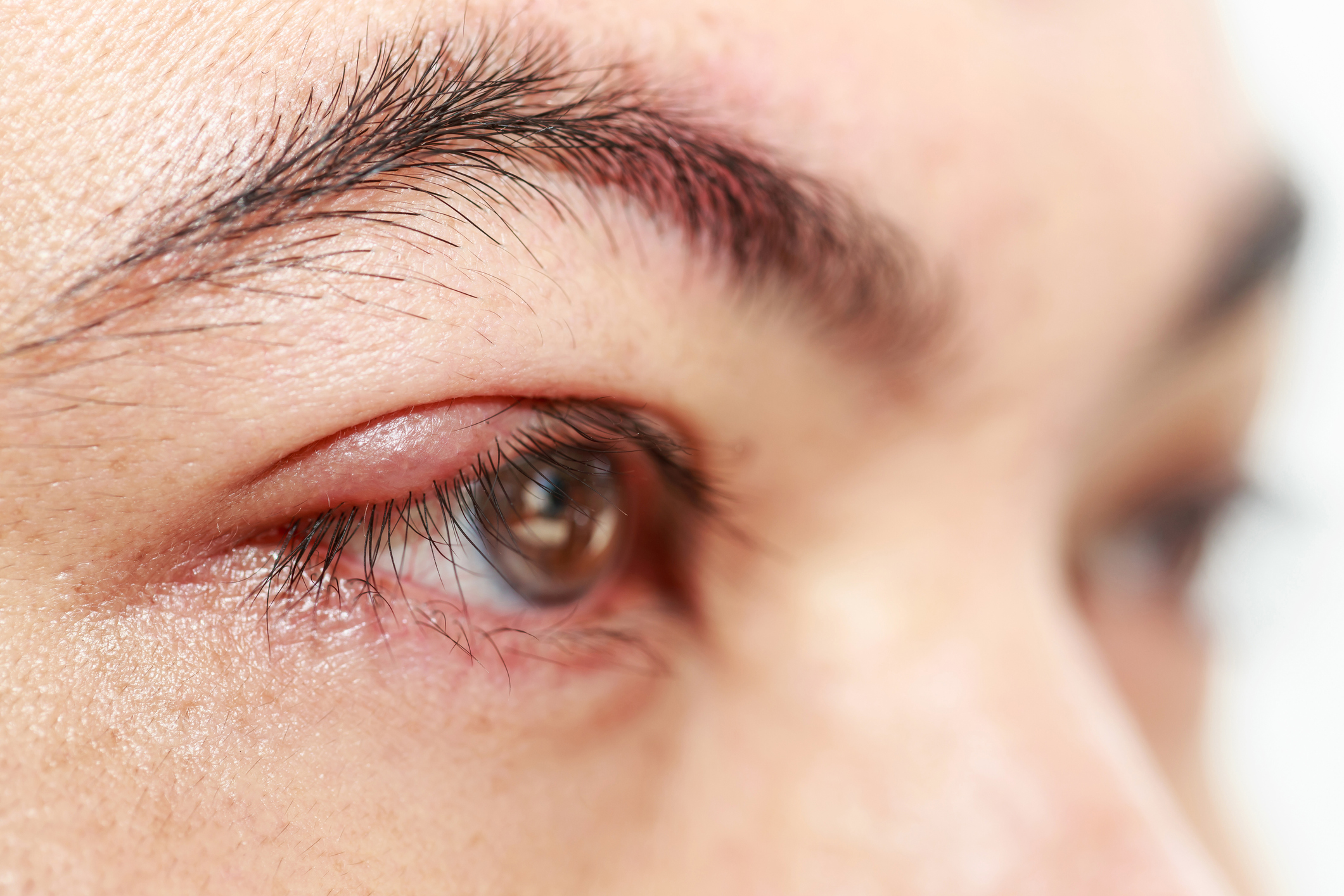 Jačmenné zrno či jačmeň na oku. Prečo vzniká, ako sa lieči? (Hordeolum + chalazion)