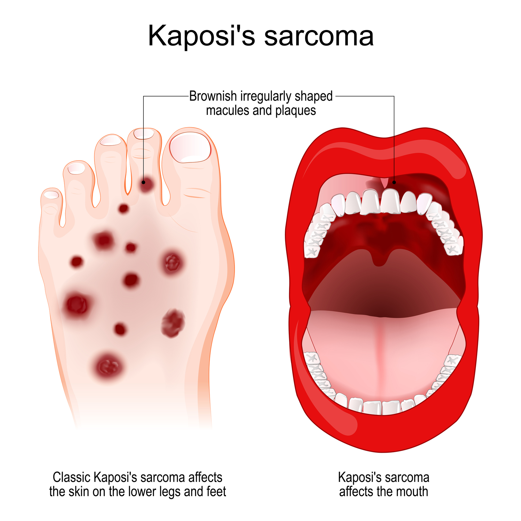 Nález Kaposiho sarkómu na dolnej končatine a v dutine ústnej