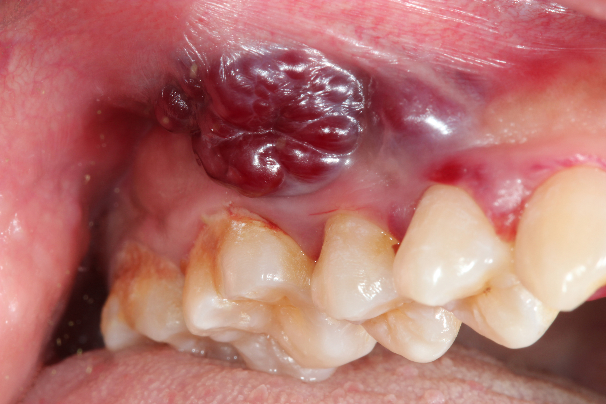 Kaposiho sarkóm v dutine ústnej