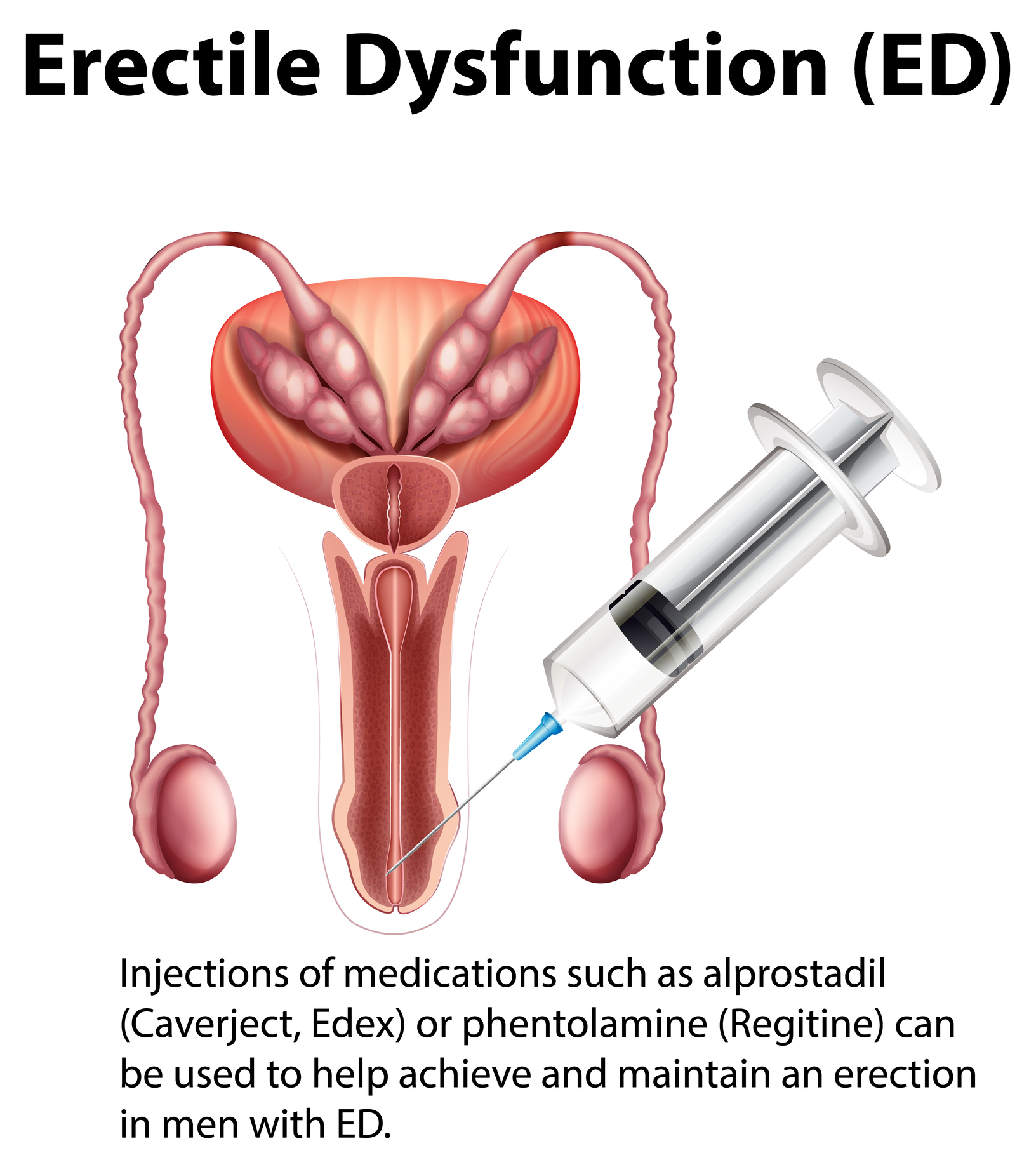 Kavernózne injekcie pre elimináciu erektilnej dysfunkcie muža