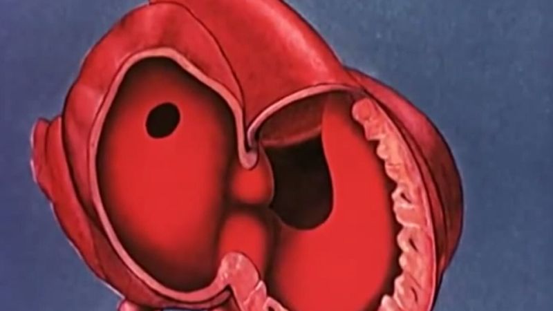 Koarktácia aorty