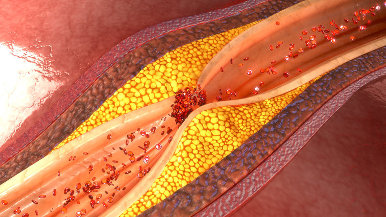 Angína pectoris a ateroskleróza a aterosklerotický plát v koronárnej, čiže srdcovej cieve