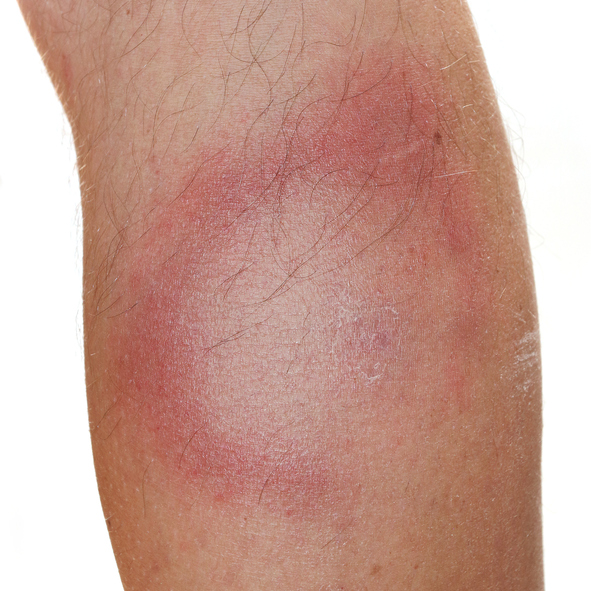 Typický príznak boreliózy, teda migrujúci erytém, začervenanie kože, s bledým centrom