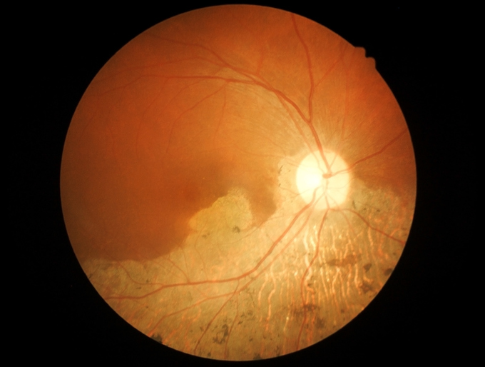 Makulárna degenerácia pri oftalmologickjom vyšetrení