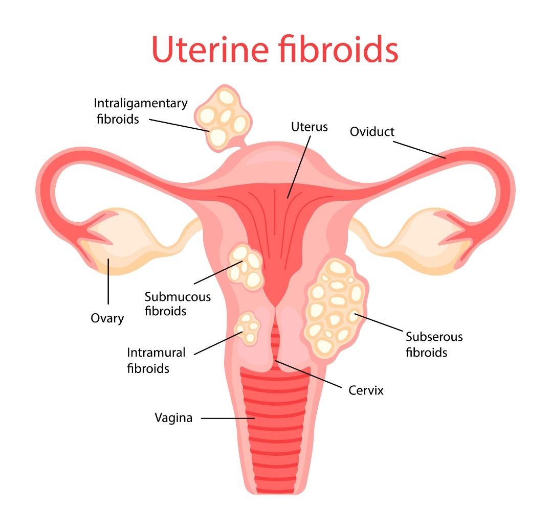 Uterine fibroids (maternicové myómy)