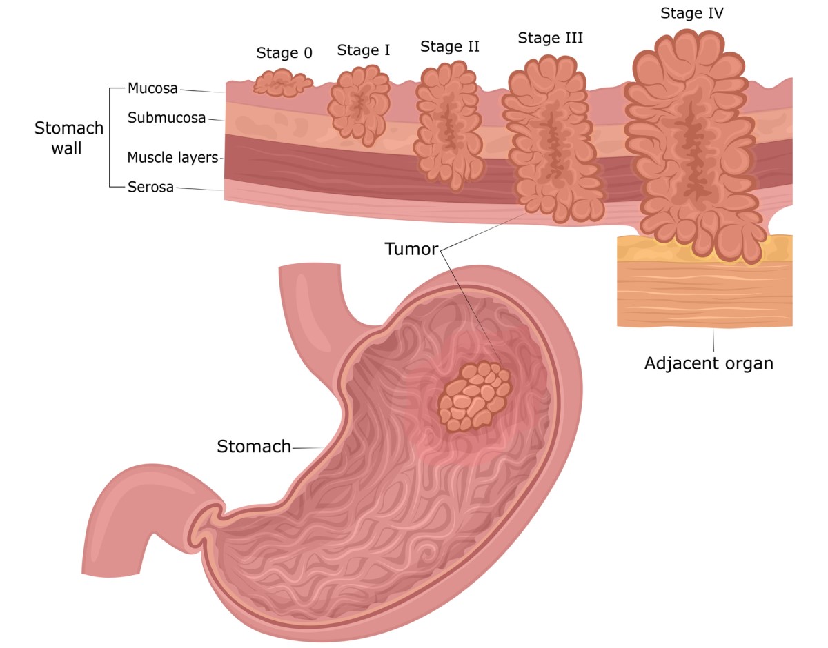 Rakovina žalúdka: vrstvy steny žalúdka (mukóza, submukóza, svalovina, seróza) a štádia rozvoja tumoru od sliznice až po blízke okolie a orgány