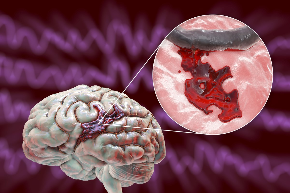 Krvácanie do mozgu ako následok prasknutia aneuryzmy mozgovej cievy - 3D model mozgu a cievy, znázorňuje krvácanie
