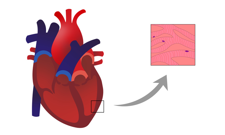 Myokarditída: zápalový proces s infiltrátom a degeneráciou kardiomyocytov v stene svaloviny srdca