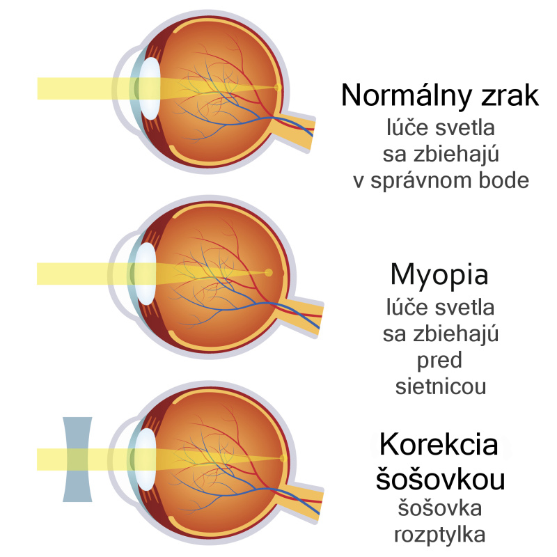 Porovnanie, ako sa lúče zbiehajú pri normálnom zraku a myopii a pri korekcii zraku šošovkou rozptylkou