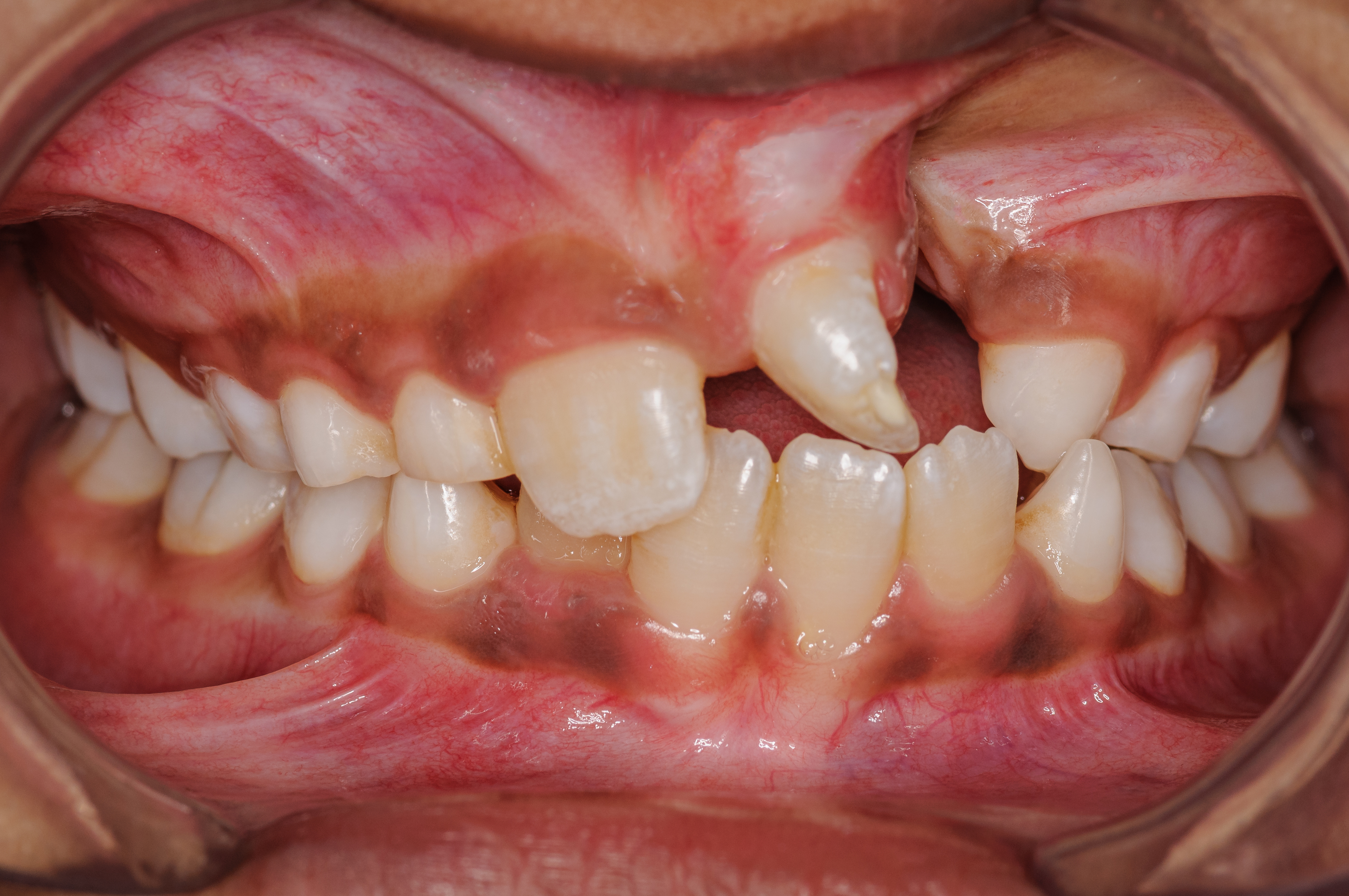 Nesprávny rast zubov pri rázštepe pery a podnebia