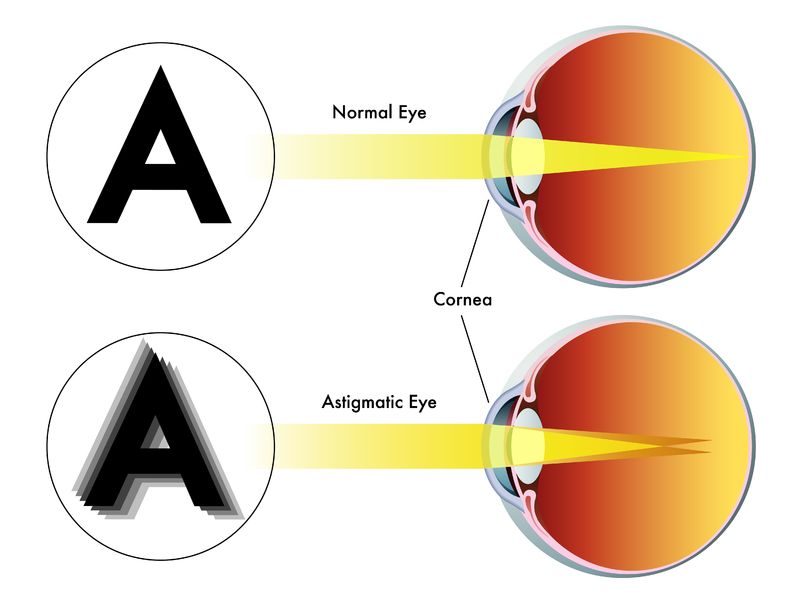ako vidí písmeno normálne oko v porovnaní s astigmatickým okom