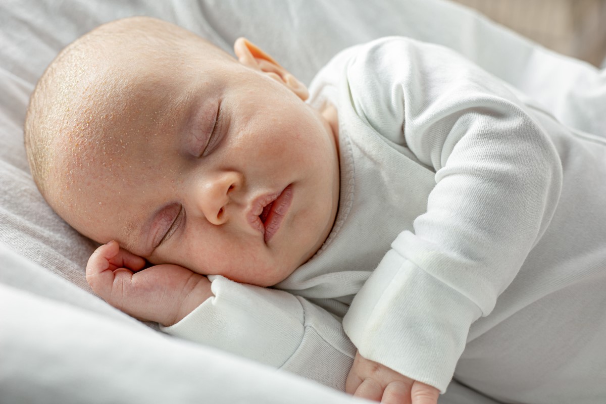 Malé dieťa, novorodenec, spí, na hlavičke má deboreu a šupiny